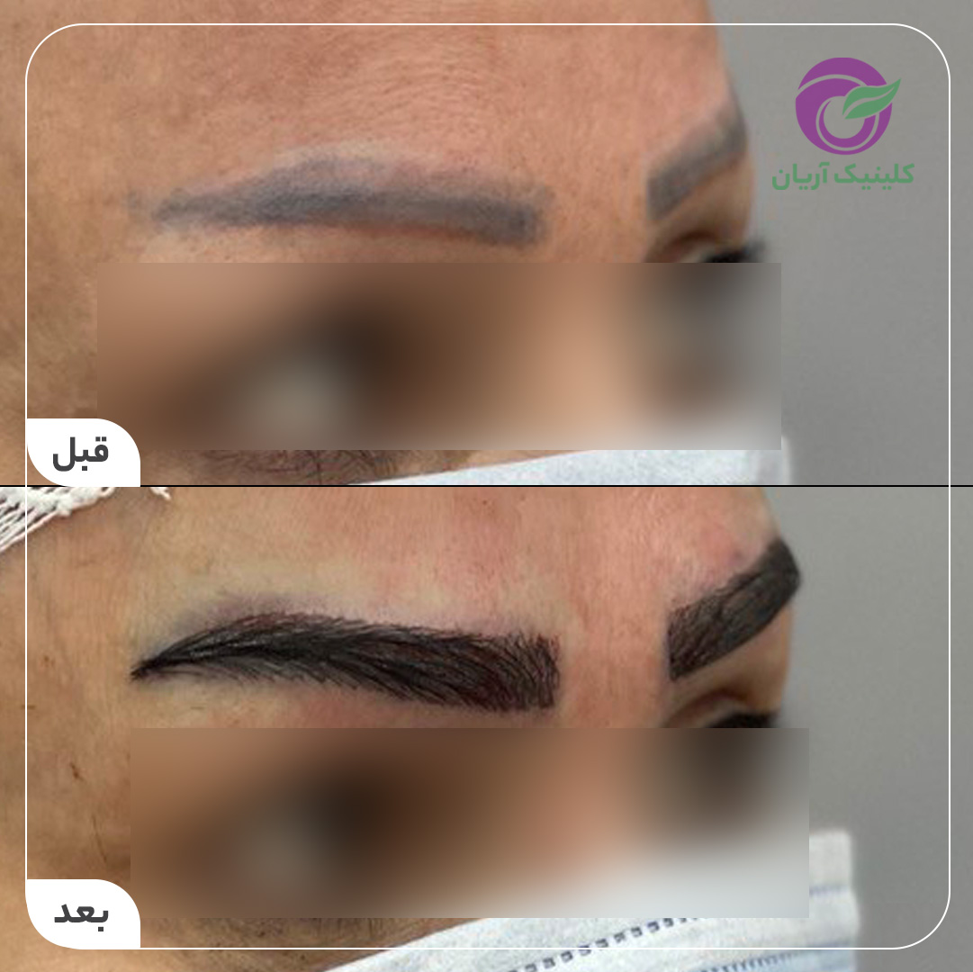 گالری فیلم کاشت ابرو